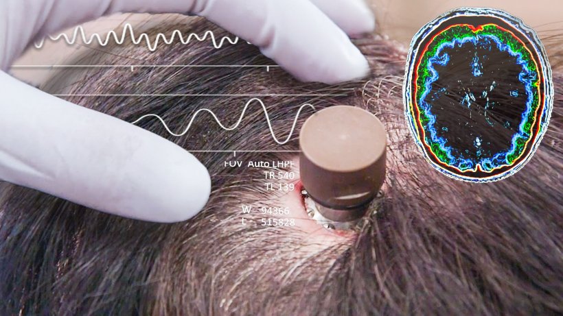 ประวัติศาสตร์! Neuralink ของอีลอนมัสก์ ฝังชิปสมองให้ผู้ป่วยสำเร็จ