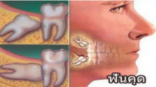 ทำไมถึงต้องผ่าฟันคุด