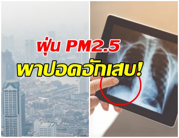 เเพทย์เตือน!! ฝุ่นPM2.5 พาปอดอักเสบ รีบรักษา อย่าปล่อยให้รุนเเรง 