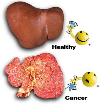 ตับอักเสบโรคร้ายที่ป้องกันได้