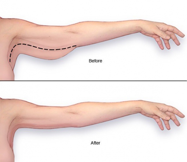 โบกมือลาปัญหาแขนใหญ่ด้วย 5 วิธีง่ายๆ