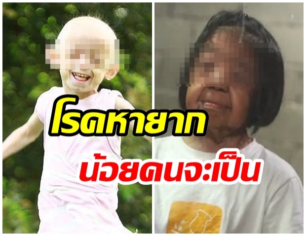 รู้จัก โรคชราในเด็ก โรคหายากพบ 1 ต่อ 8 ล้านคน