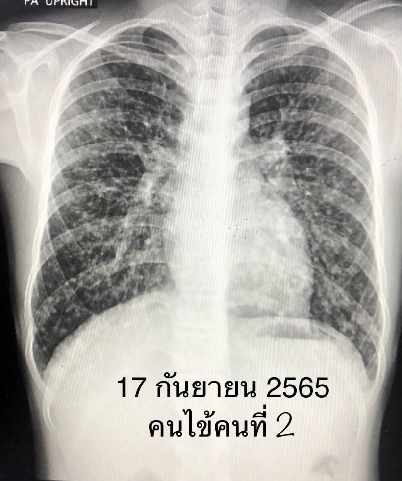 ช็อก! ชมค้างคาว ในโพรงต้นไม้ เจอเชื้อราในปอด ระวังป่วยโรคนี้อันตรายมาก