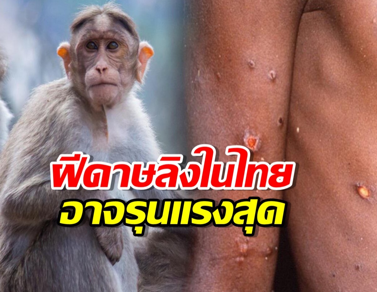 หมอธีระ เปิดข้อมูล หวั่น ฝีดาษลิง ในไทยอาจหนักกว่าทั่วโลก