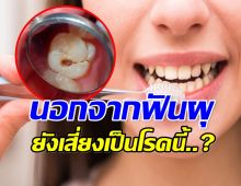 น่ากลัวกว่าที่คิด! ไม่แปรงฟันก่อนนอน เสี่ยงเป็นโรคนี้