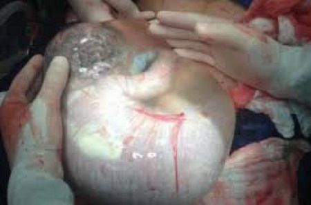 แพทย์ตะลึง พบทารกยังห่อตัวในถุงน้ำคร่ำก้อนใหญ่ หลังรับการผ่าท้องจากครรภ์มารดา