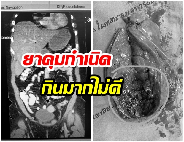 เเพทย์เตือน ภัยร้ายจากยาคุมกำเนิน กินมากๆระวังเป็นมะเร็งตับ