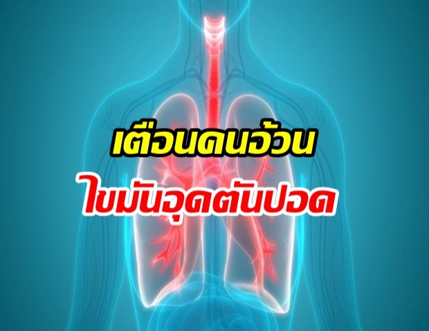 เตือนคนอ้วนระวังไขมันอุดตันในปอด ก่อโรคหอบหืด-หายใจลำบาก