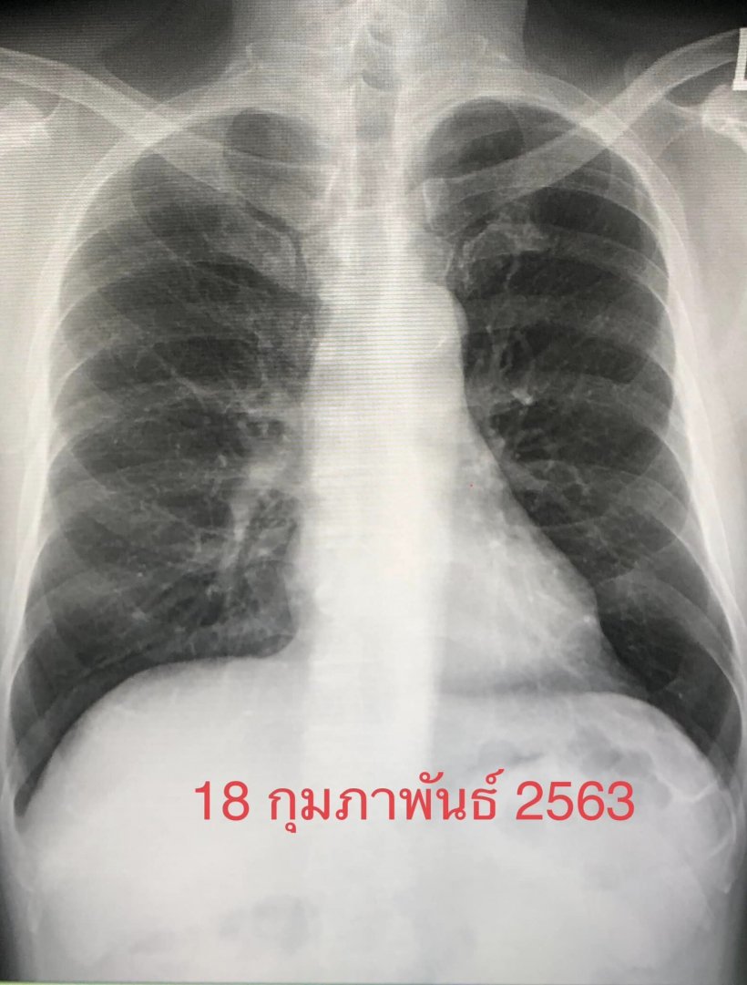 อุทาหรณ์ โควิดระบาด ผู้ป่วยพลาดตรวจร่ายกาย สุดท้ายเสียชีวิตเพราะโรคนี้?