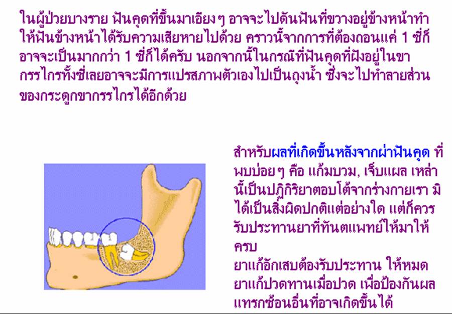 ฟันคุด..เจ็บจัง