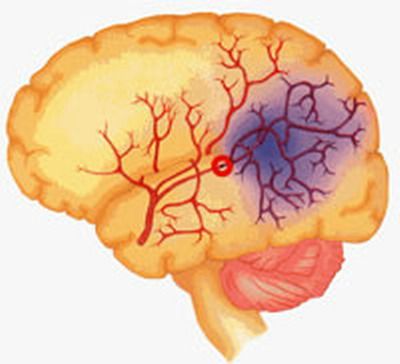 อาการบอกตำแหน่งหลอดเลือดสมองผิดปกติ