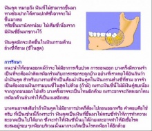 ฟันคุด..เจ็บจัง