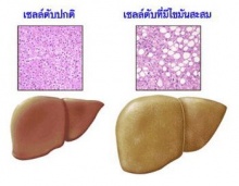 ใครเสี่ยง? ไขมันพอกตับ 