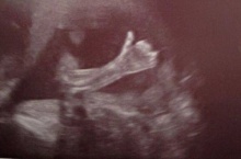 อึ้ง! ภาพ อัลตร้าซาวด์ลูกในท้อง เห็นทารก ยกนิ้วให้ !!