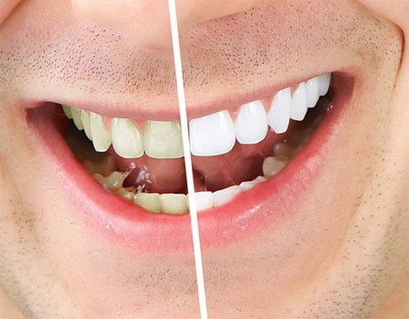 วิธีกำจัดคราบเหลืองบนผิวฟันด้วยวัตถุดิบที่หาได้ง่าย ๆ