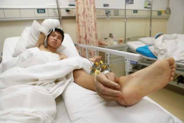 แพทย์จีนปลูกถ่ายมือที่ข้อเท้า