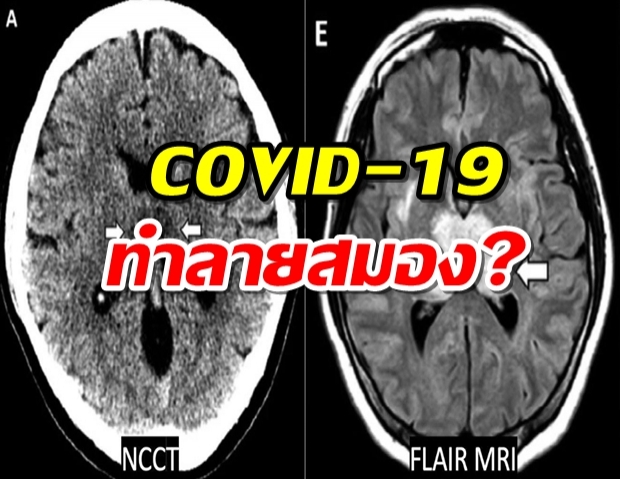 ข้อมูลใหม่ COVID-19 ทำสมองเสียหายหนัก 
