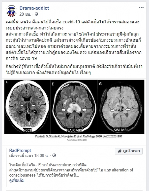 ข้อมูลใหม่ COVID-19 ทำสมองเสียหายหนัก 