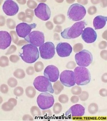 มะเร็งเม็ดเลือดขาว(leukemia)