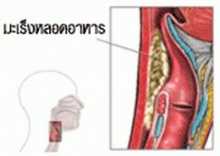 มะเร็งหลอดอาหาร