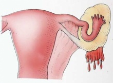 ช็อกโกแลตซีส (cyst) โรคภายในที่ผู้หญิงควรรู้