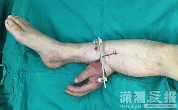 สุดเหลือเชื่อ! ผ่าตัดพิสดารเย็บมือคนไข้ขาดไว้ที่เท้า ก่อนรักษาได้อย่างฉลุย