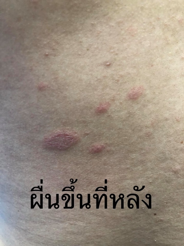 โรคพบบ่อยในเด็ก เฮอร์แปงไจนา เจ็บคอ ผื่นแผลในปาก แนะล้างมือบ่อยๆป้องกันโรค