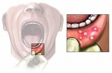โรคร้อนในในปาก สาเหตุ กับ วิธีรักษา