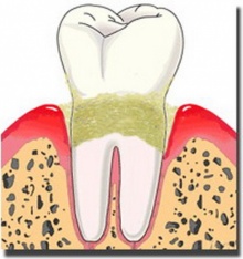 เหงือกก็เป็นหน้าต่างของหัวใจ รำมะนาดชี้ทางลิ้น หัวใจเป็นโรค