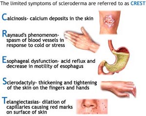 โรคหนังแข็ง (scleroderma)